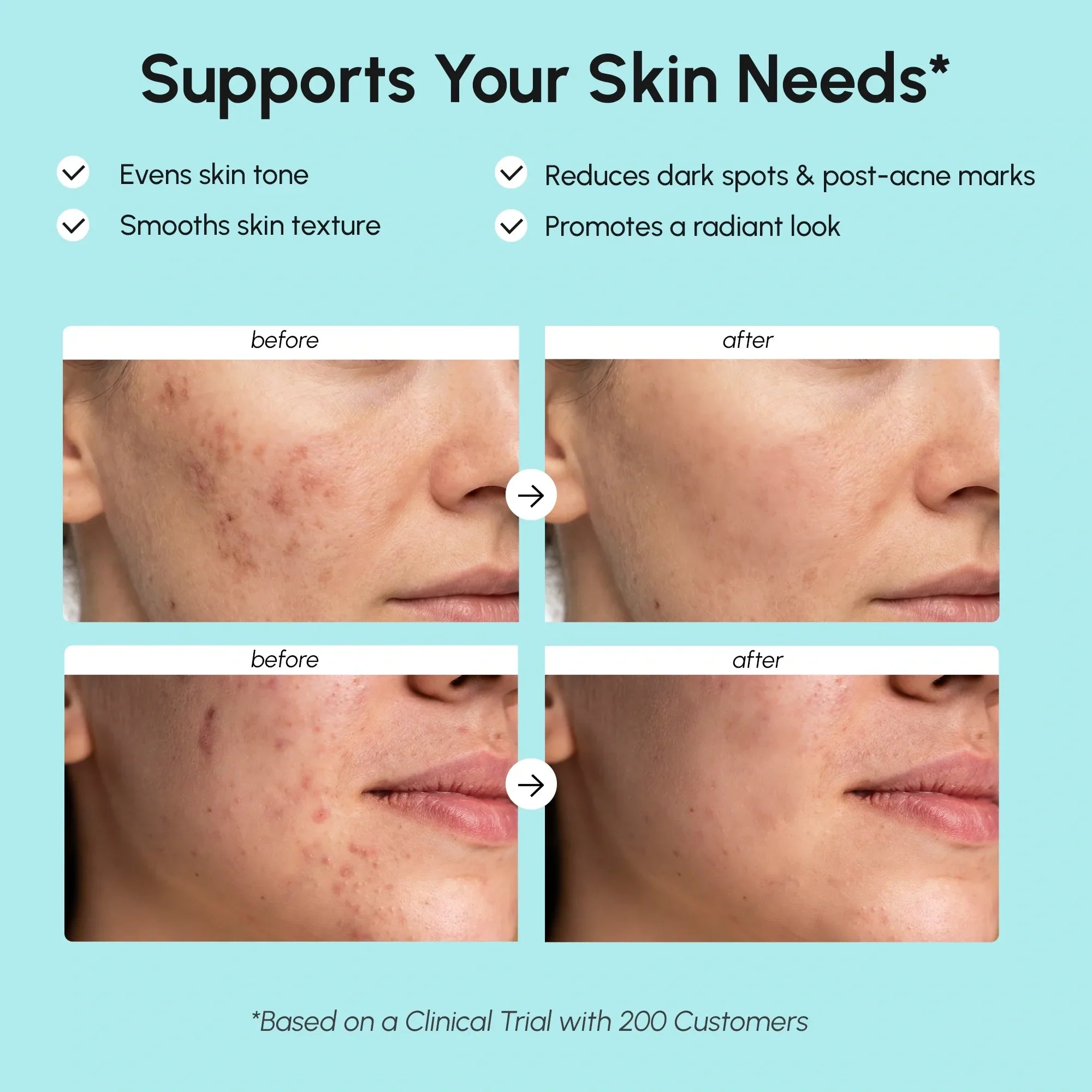 Azelaic Acid Cream for Sensitive Skin